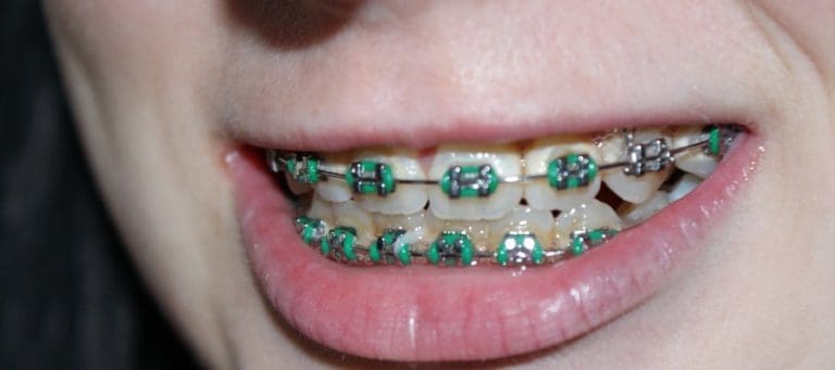 Aparaty ortodontyczne